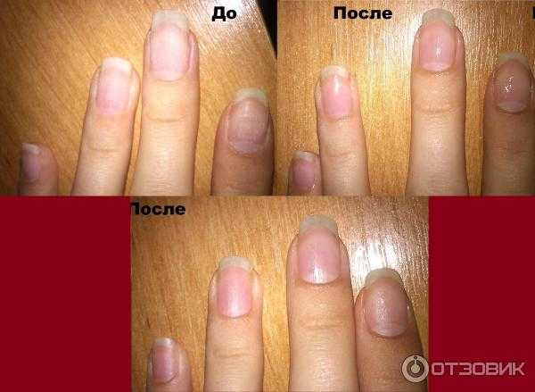 Как быстро восстановить ногти после гель-лака
