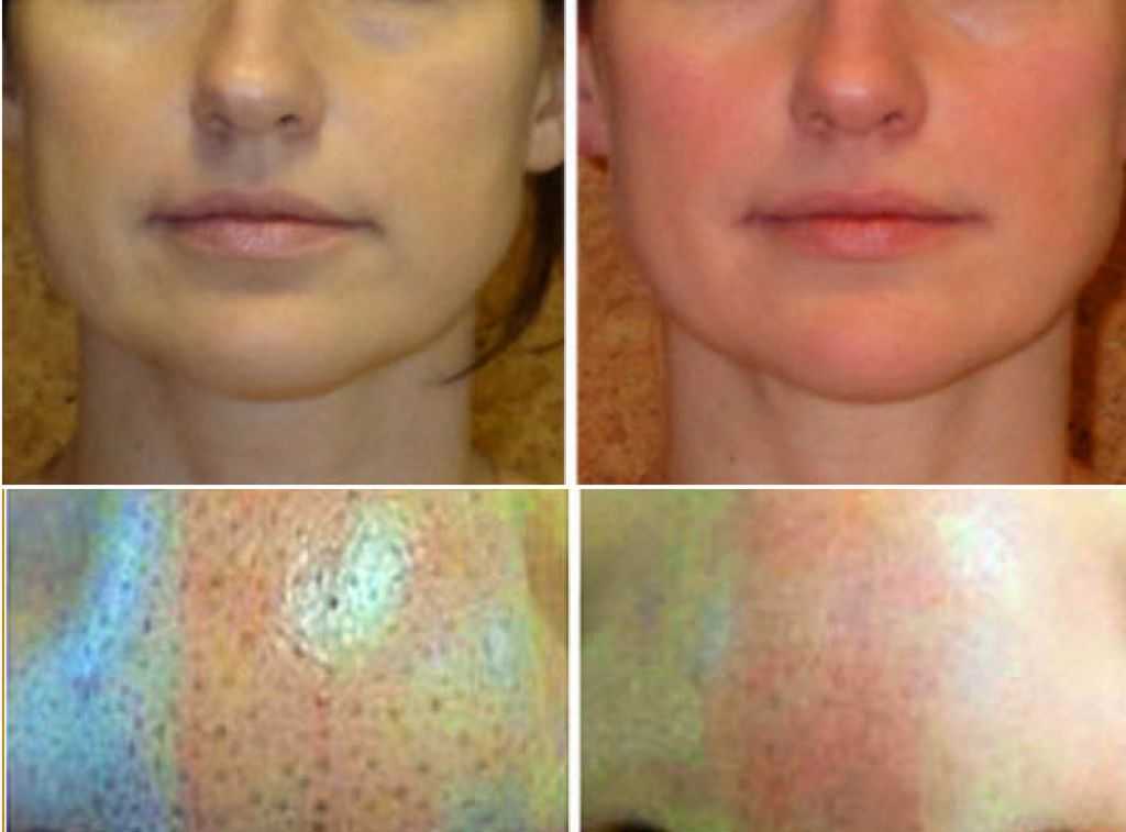 Какие процедуры помогают сузить поры на лице?