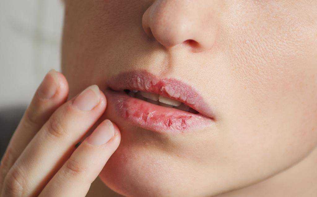 Сухость губ летом может возникать по разным причинам, но отнестись к этой проблеме стоит серьезно Читай, почему сохнут губы и как устранить сухость губ, чтобы они вновь были нежными и красивыми
