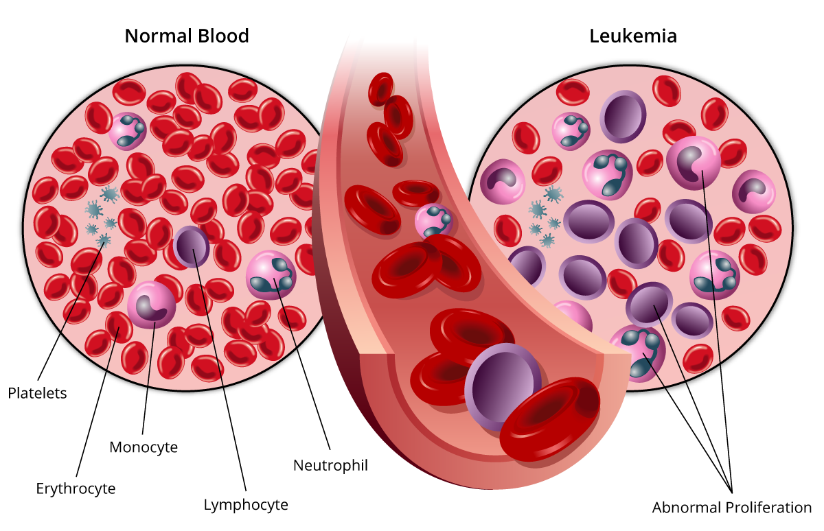 Лейкоз клетки крови. Острый лейкоз кровяные клетки. Эритроциты. Опухоль клеток крови