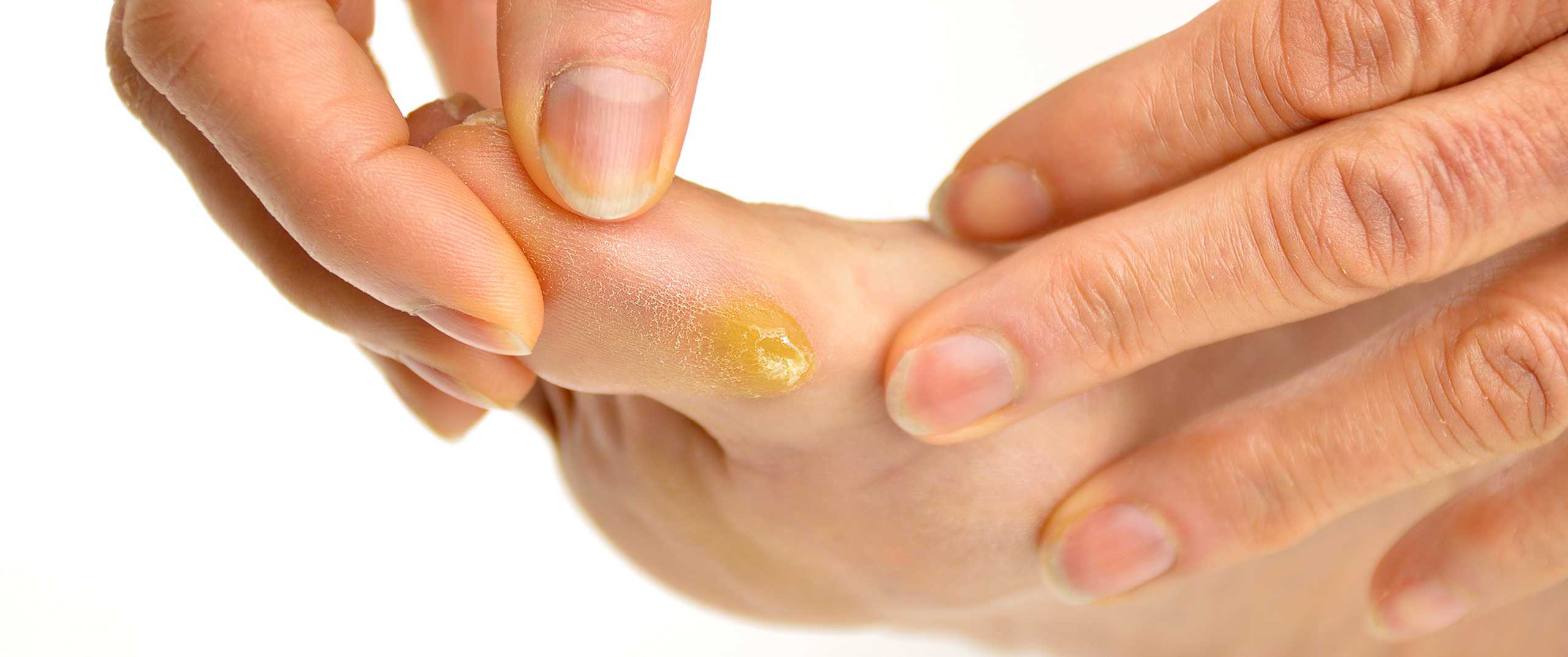 Лечение грибка между пальцами ног