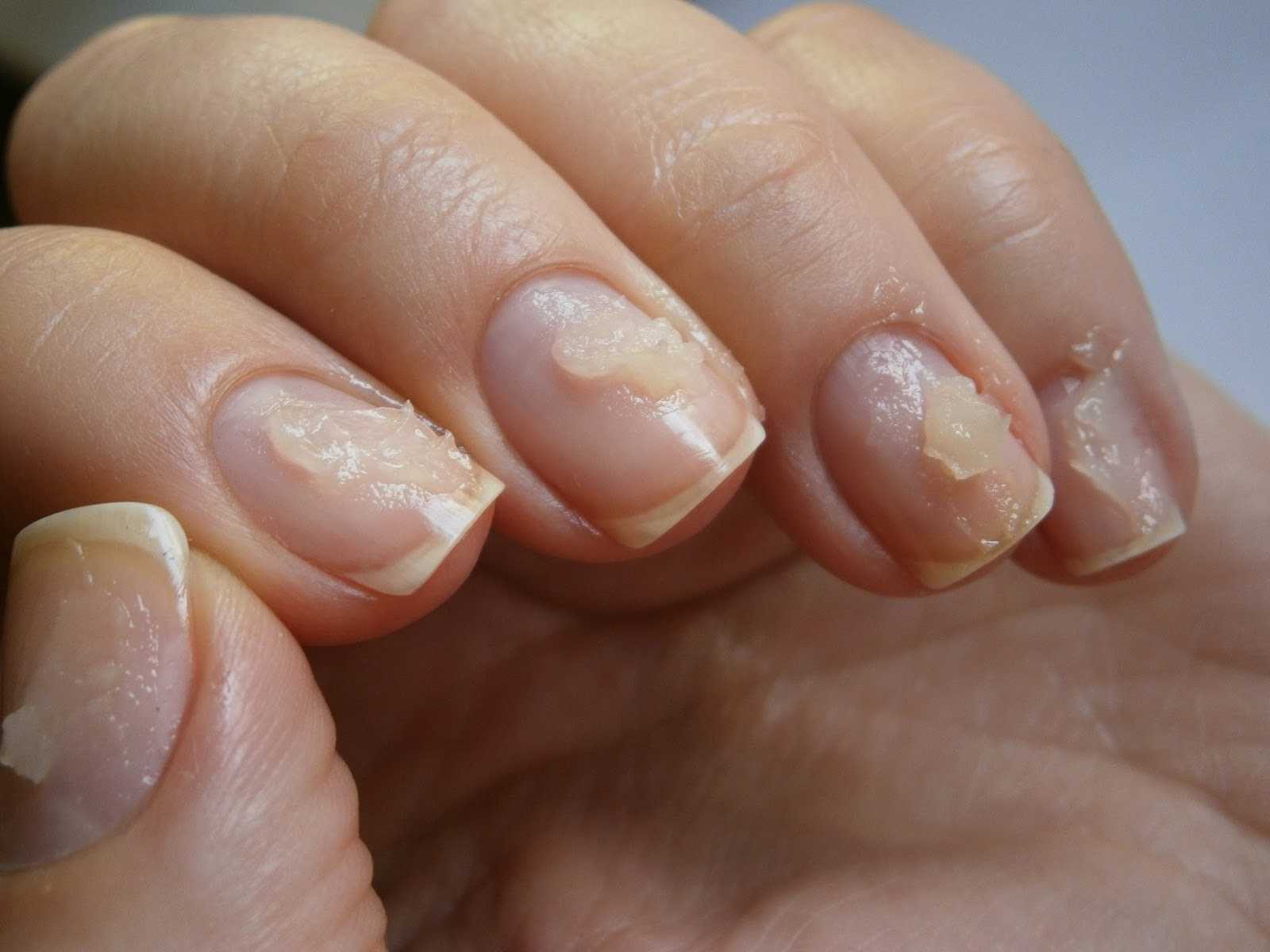 Почему отслаиваются наращенные гелем ногти у основания и от свободного края