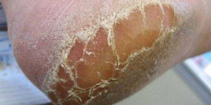 Сухая кожа зимой на лице и теле: что делать, симптомы, причины, профилактика
