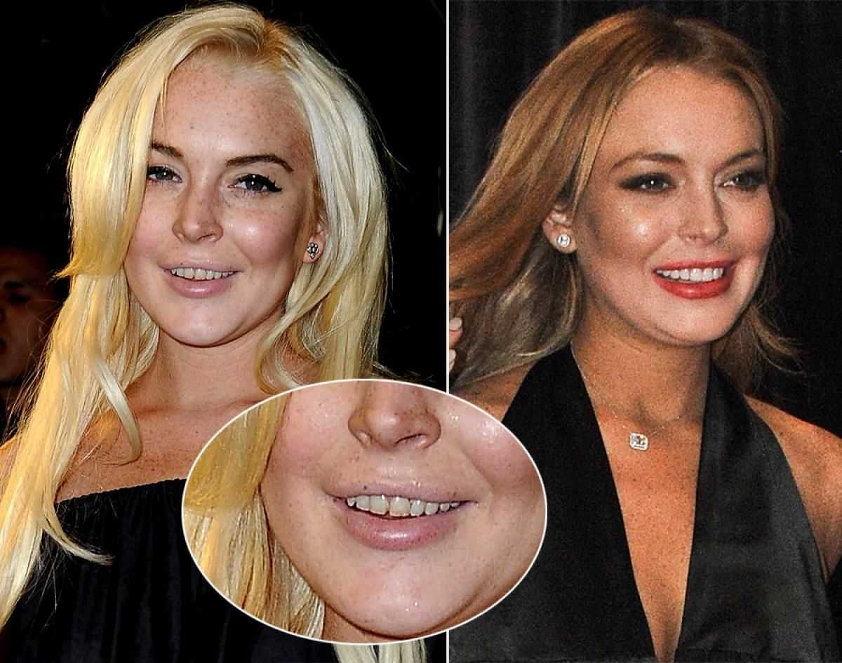 Зубы у звезд до и после фото