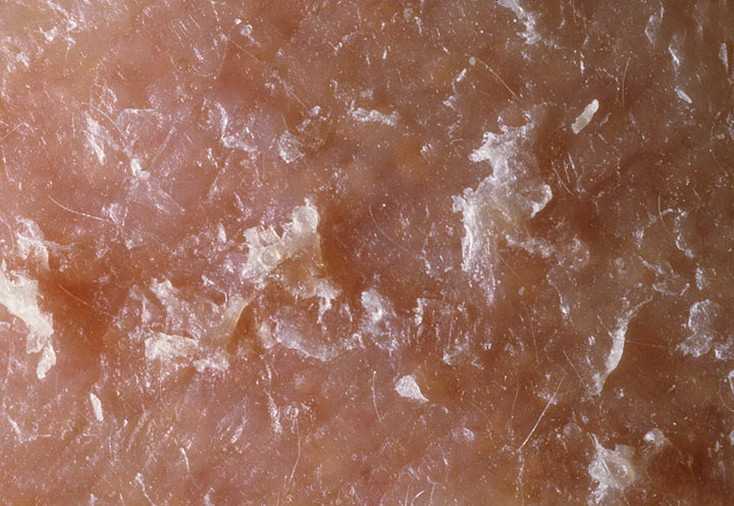 Фолликулярный кератоз, или гусиная кожа: какой уход поможет с ней справиться | vogue russia