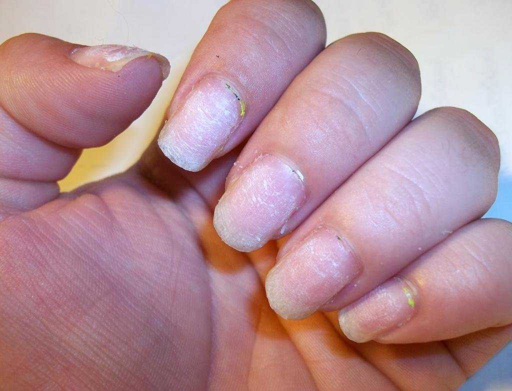 Причины отслоения наращенных гелем ногтей
