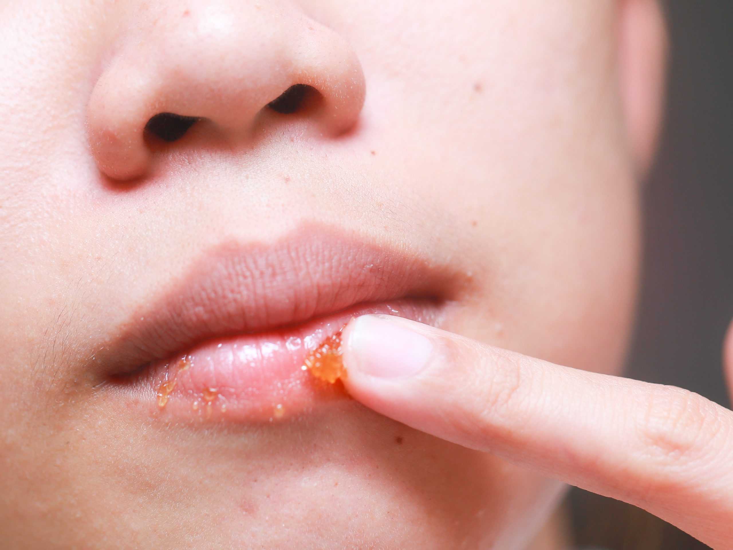 5 ошибок при увеличении губ гиалуроновой кислотой