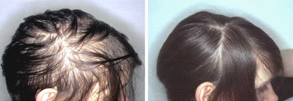 Преждевременное поседение волос: выясняем причины и принимаем меры