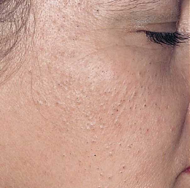 Гиперкератоз на лице | гель клиндовит
