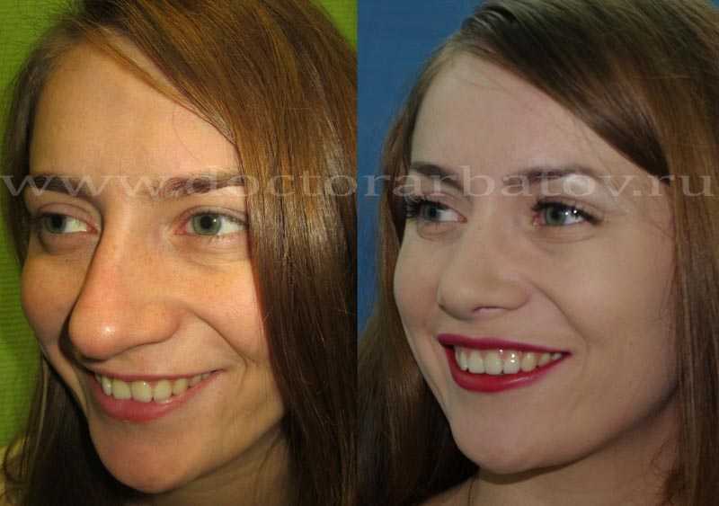 Пластические операции блогеров: как хирургия изменила внешность инфлюенсеров (фото до и после)
