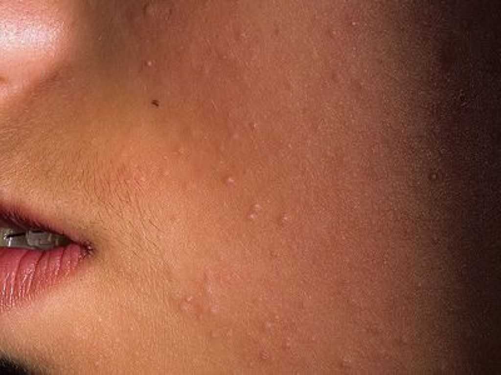 Что такое себорейная кератома кожи: причины, симптомы, диагностика и удаление - дерматология