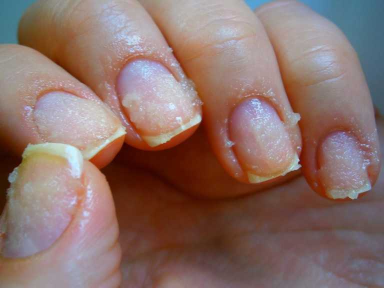 Как восстановить ногти после наращивания? — modnail.ru — красивый маникюр