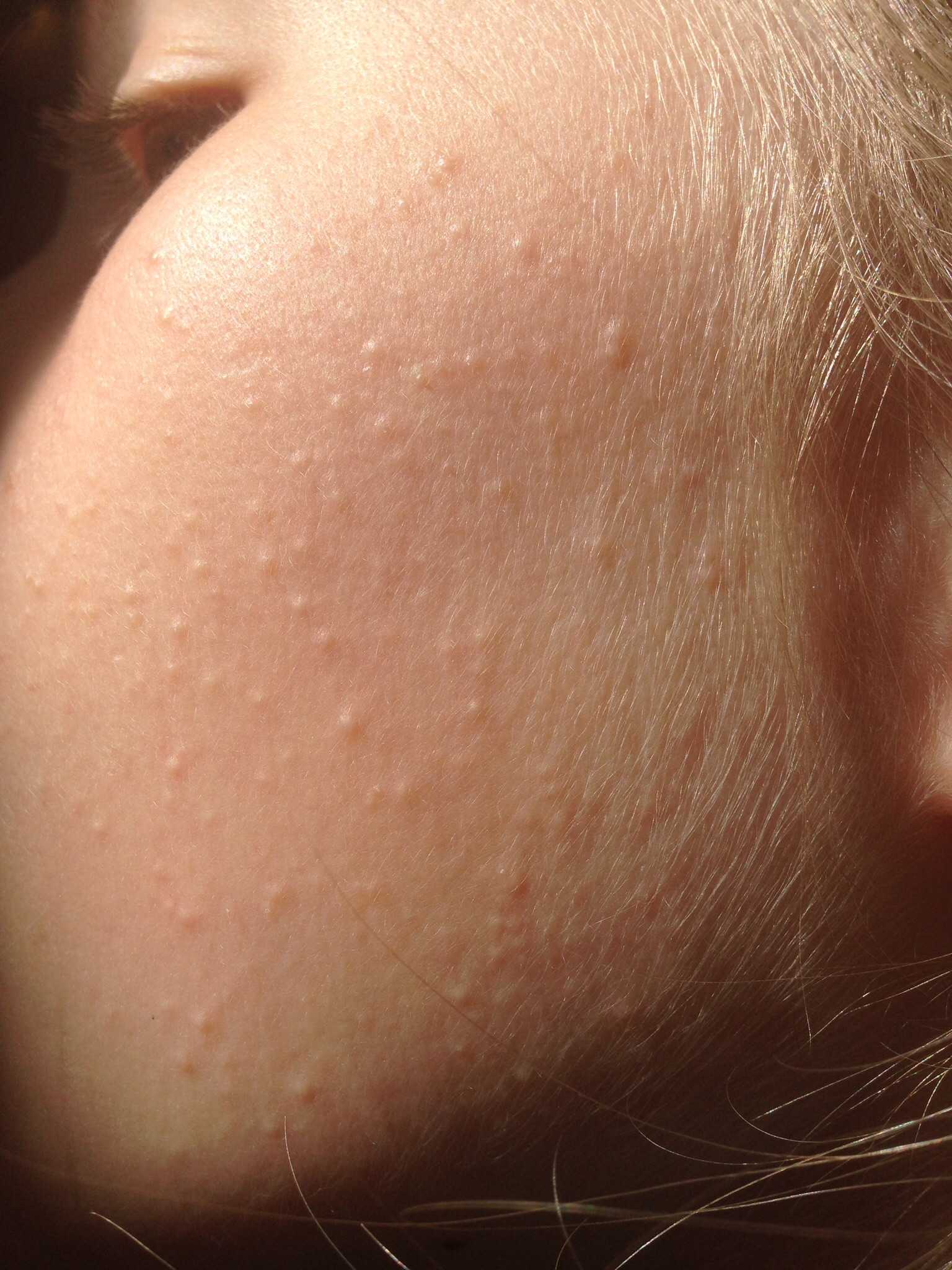 Гусиная кожа: как справиться с фолликулярным кератозом