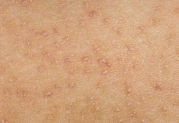 Лечение актинического кератоза кожи лица лазером | атлантик